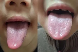 小兒反覆感冒，中醫從脾虛食積論治，療效顯著