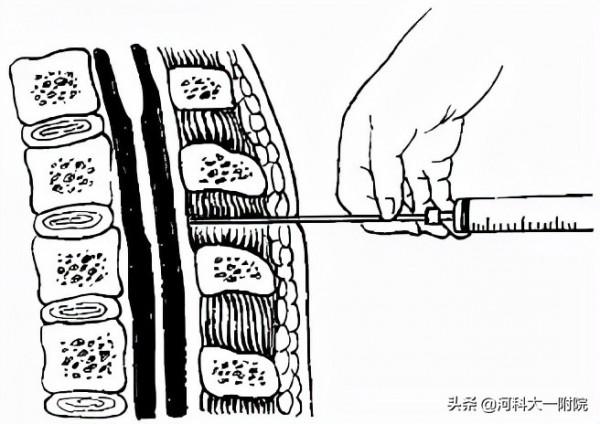 “與癌共舞”一年半，鞘內化療讓帶癌生存成為可能