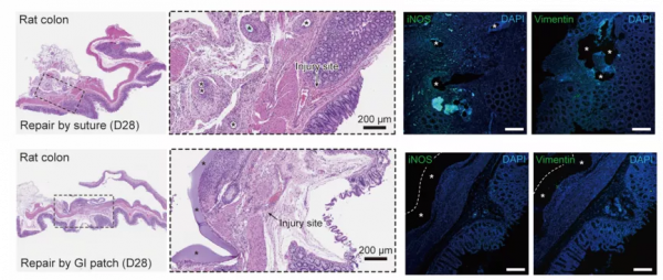 華科校友研發可降解&OpenCurlyDoubleQuote;腸道創可貼&rdquo;，能用於胃腸道缺損無縫修復