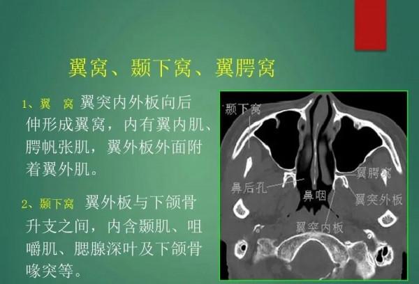 頭頸五官CT斷層解剖圖及常見病影像診斷