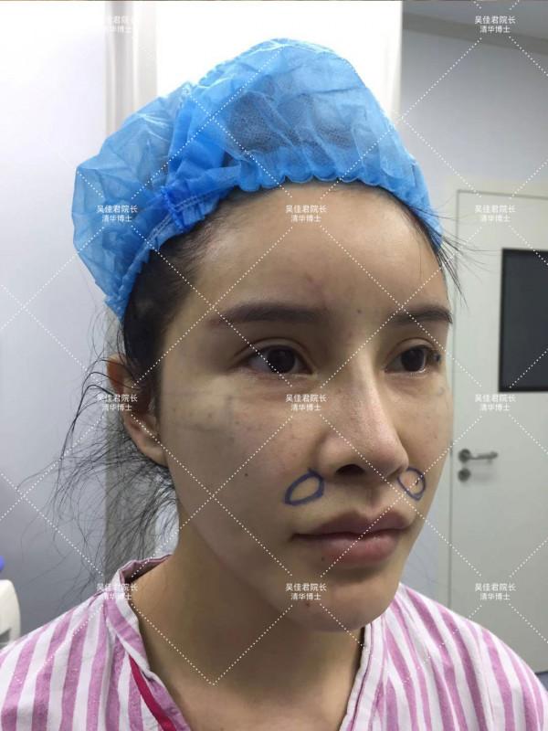 32歲姑娘小拉皮術後7個半月，變得年輕又精緻，前後反差很大