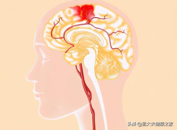 家裡老人突發腦溢血，懂得急救很重要：4個步驟記清楚，能救命