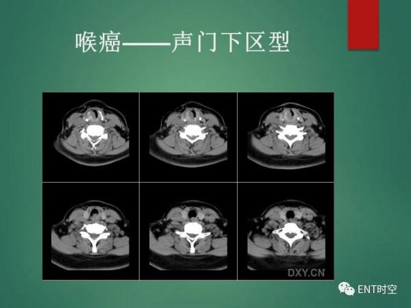頭頸五官CT斷層解剖圖及常見病影像診斷