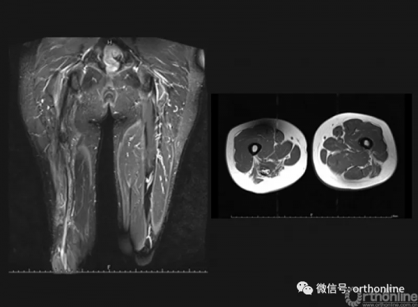 硬纖維瘤無法切淨怎麼辦?中山一院為臨床帶來創新方案 硬纖維瘤無法切淨怎麼辦?中山一院為臨床帶來創新方案