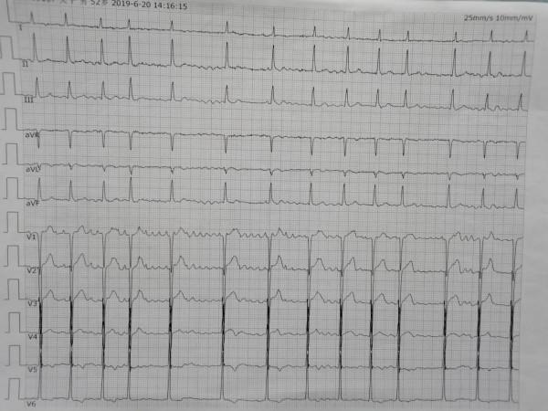房顫的心電圖分析訣竅和房顫的科普解釋,專業和通俗的完美結合 房顫的心電圖分析訣竅和房顫的科普解釋,專業和通俗的完美結合