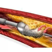 冠脈狹窄,還嚴重鈣化?2毫米的“金剛鑽”救了七旬老人一命…… 冠脈狹窄,還嚴重鈣化?2毫米的“金剛鑽”救了七旬老人一命……