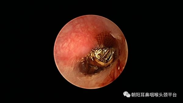 耳朵進了東西怎麼辦？