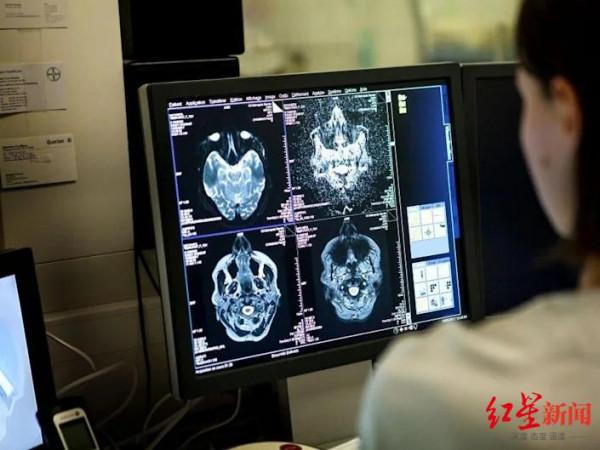 高達84%新冠感染者出現後遺症,最新研究:新冠病毒還能殺死腦細胞 高達84%新冠感染者出現後遺症,最新研究:新冠病毒還能殺死腦細胞