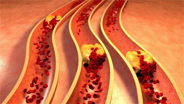 甘油三酯和膽固醇都是高血脂，有什麼區別？如何降低？