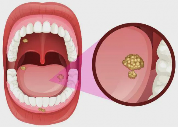 疫情期間遇上牙病該怎麼辦？