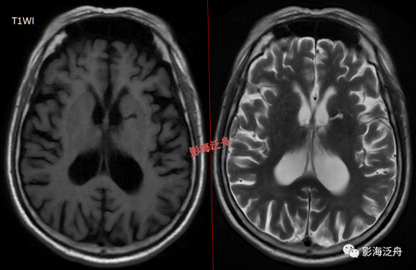 VR腔隙、腔梗灶、微出血、脫髓鞘，傻傻分不清？快看這裡