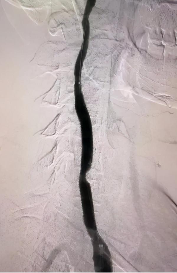 年輕小夥“甩頭”過猛，脖子鼓起一個“包”，血管差點破裂