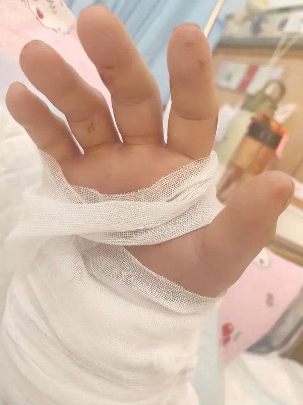 6小時徹夜奮戰保肢成功——北京積水潭醫院手外科完成2022年首例斷肢再植手術