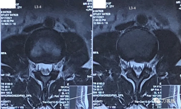 27歲女性，兩間隙腰椎間盤突出症，6顆釘子，4個融合器