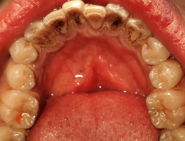 刷牙能代替洗牙嗎?洗牙會把牙縫變大?延安醫院為你解答 刷牙能代替洗牙嗎?洗牙會把牙縫變大?延安醫院為你解答
