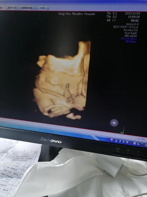 孕30周的四維彩超單，能看出來是男孩兒女孩兒嗎？