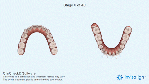 全球優秀案例 | 隱適美拔牙矯正1年半時間解除牙列間隙、改善嘴凸 全球優秀案例 | 隱適美拔牙矯正1年半時間解除牙列間隙、改善嘴凸