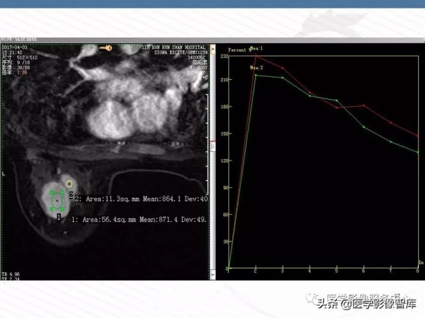 乳腺T2WI高訊號腫瘤病變的診斷思路 乳腺T2WI高訊號腫瘤病變的診斷思路