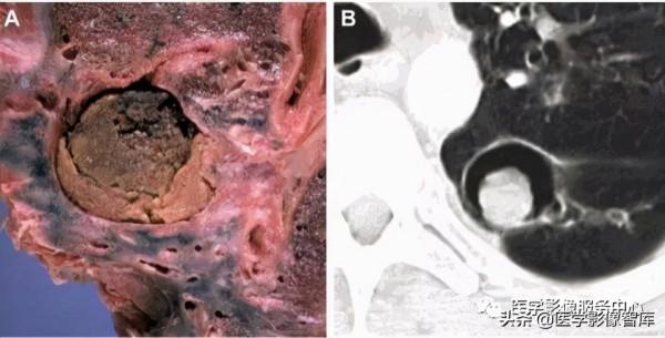 22個肺部疾病的CT徵象 22個肺部疾病的CT徵象