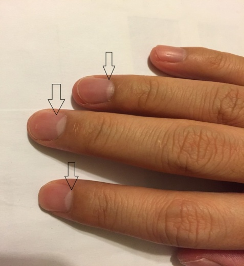 你的腎好不好，看指甲就知道！醫生：指甲長成這樣的要小心了