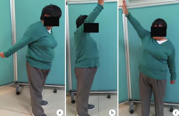 長在肩膀上的“結石”:6旬阿姨肩膀半夜痛醒誤以為肩周炎,原來是肩袖鈣化性肌腱炎 長在肩膀上的“結石”:6旬阿姨肩膀半夜痛醒誤以為肩周炎,原來是肩袖鈣化性肌腱炎