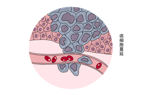 癌症是如何“殺死”一個人的？它也會因此而死，為何還那麼做？