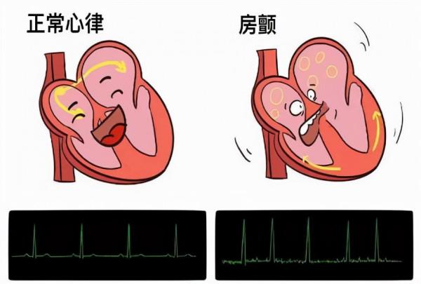 預防房顫中風，丟掉阿司匹林！