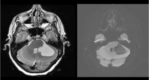 9種腦部病變,一文識別丨臨床必備 9種腦部病變,一文識別丨臨床必備