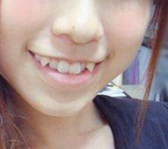 牙齒畸形，只知道“地包天”？各種畸形一文講清