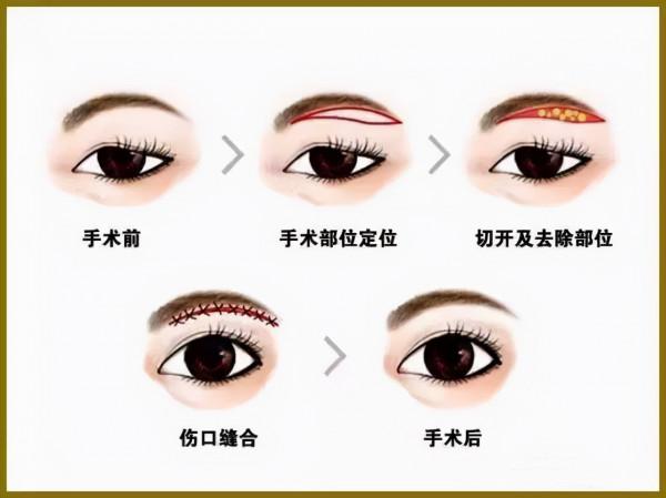 為什麼天生的雙眼沒有了？解讀消失的雙眼皮