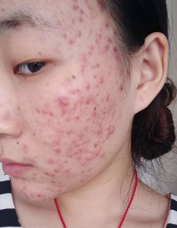 治療青春痘的方法被找到了? 治療青春痘的方法被找到了?