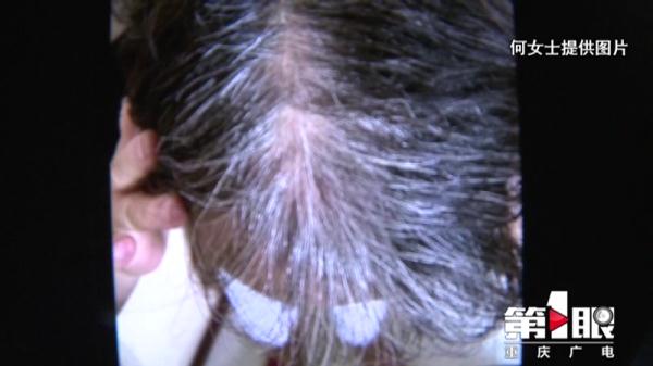 女子花4萬做“白髮轉黑”,結果治療就是拔白頭髮,網友:我媽差點嘗試了 女子花4萬做“白髮轉黑”,結果治療就是拔白頭髮,網友:我媽差點嘗試了