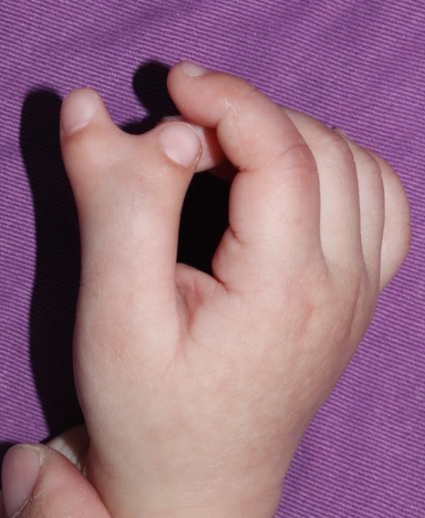 醫生，我孩子的手指做完怎麼還歪？