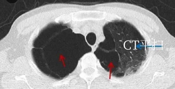 肺大泡相關（診治）問題