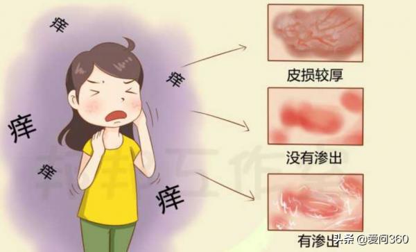 溼疹癢得難受,小妙招幫你解憂,告別反覆發作的溼疹 溼疹癢得難受,小妙招幫你解憂,告別反覆發作的溼疹