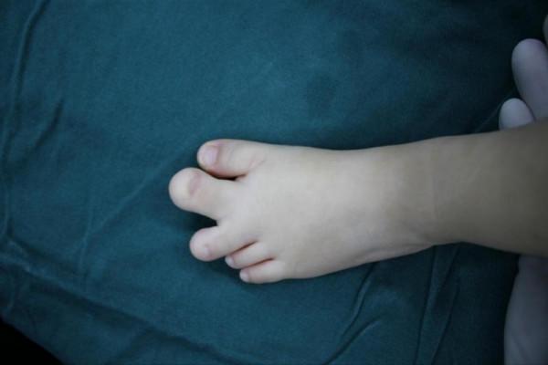 小童生出兩根“巨趾”，減容截骨成功為其腳趾“瘦身”