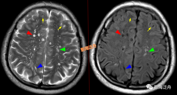 VR腔隙、腔梗灶、微出血、脫髓鞘，傻傻分不清？快看這裡