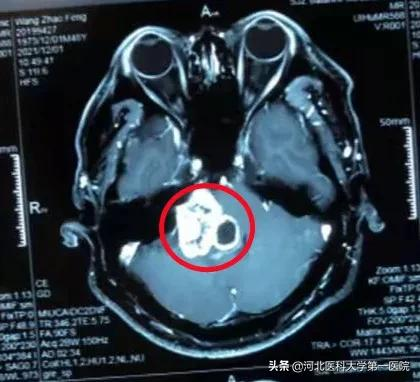 聽力下降3年，幾近失聰，他說：沒想到，手術的效果會這麼好