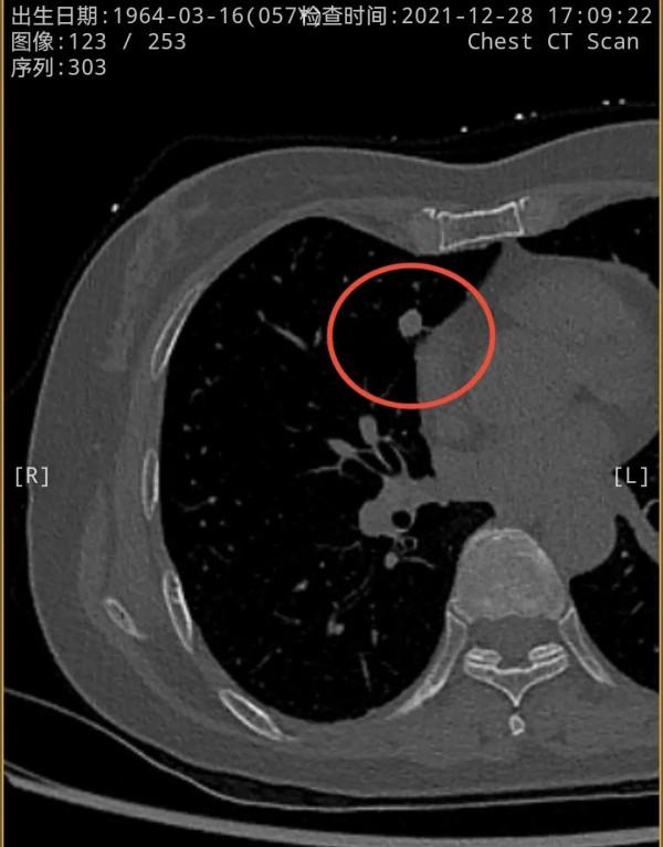 右肺多發實性結節2年多了，我們該怎麼看待？