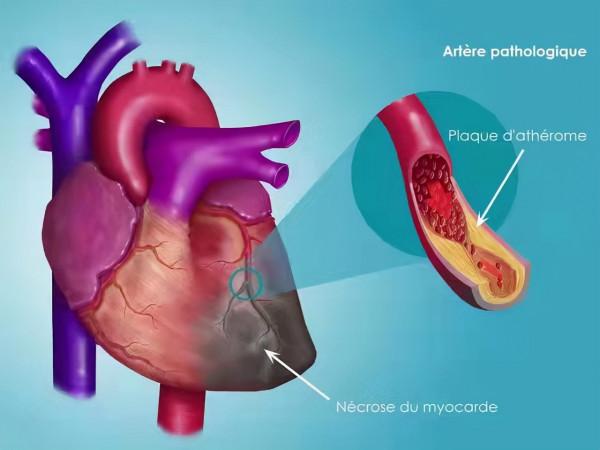 冠心病的治療不只有阿司匹林和他汀，聽醫生怎麼說