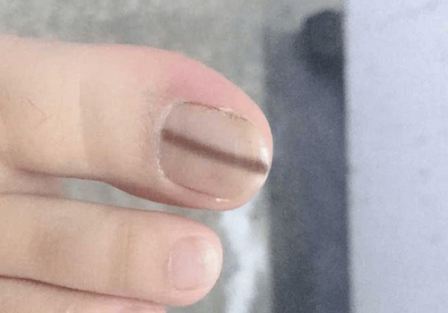 指甲上的月牙越大、越多，身體就越好？真相可能不是你想的那樣