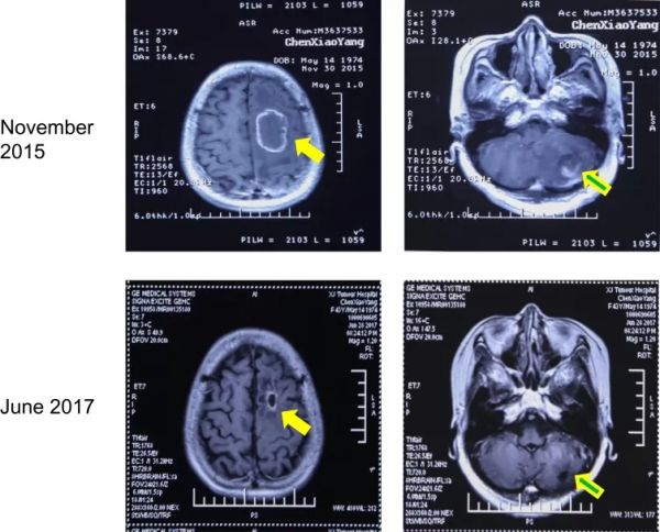 「案例」吸入氫氣後肺癌腦轉移完全消失 「案例」吸入氫氣後肺癌腦轉移完全消失