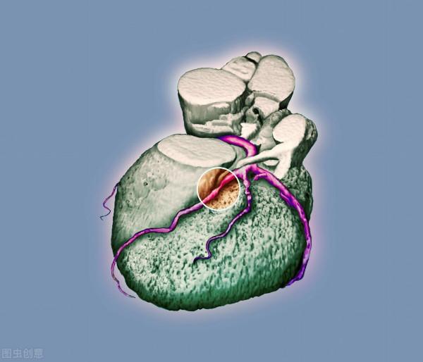 40歲冠脈重度狹窄，醫生卻說不用下支架！“狹窄”不一定都是真的