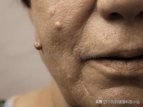 什麼是脂肪瘤，它會癌變嗎，我們應該怎麼正確治療脂肪瘤