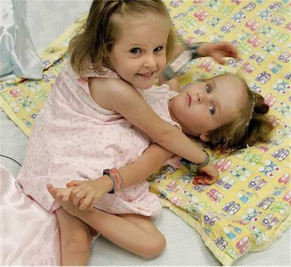 雙胞胎女嬰腹部相連醫生都說活不了，4歲做分離手術如今已滿20歲