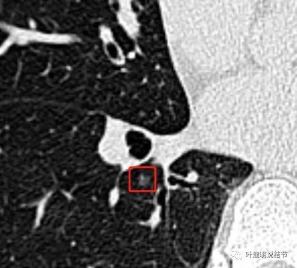 醫生也會錯：有關肺結節幾個需要澄清的關鍵問題