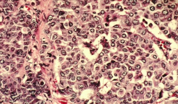 融資超72億！羅氏三連投腫瘤早篩新銳