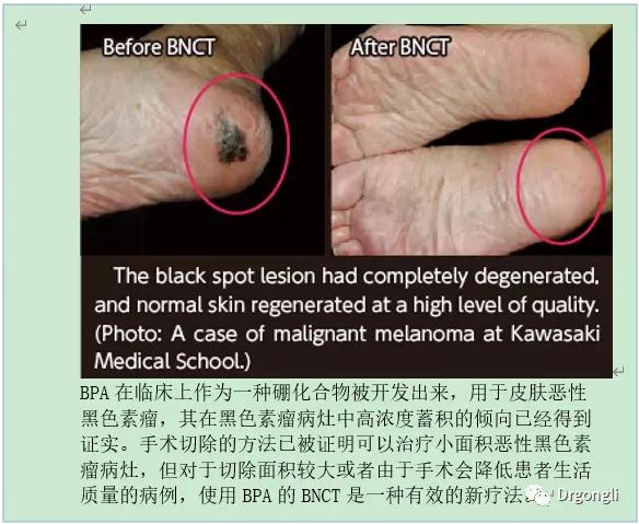 硼中子俘獲治療BNCT 硼中子俘獲治療BNCT