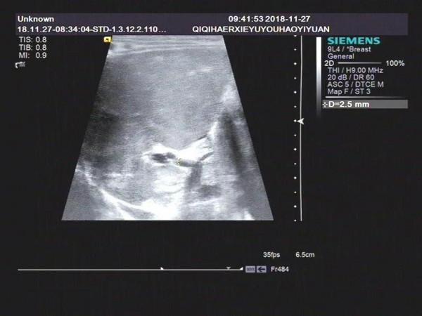 淺析幼兒黃疸之膽道閉鎖的超聲表現