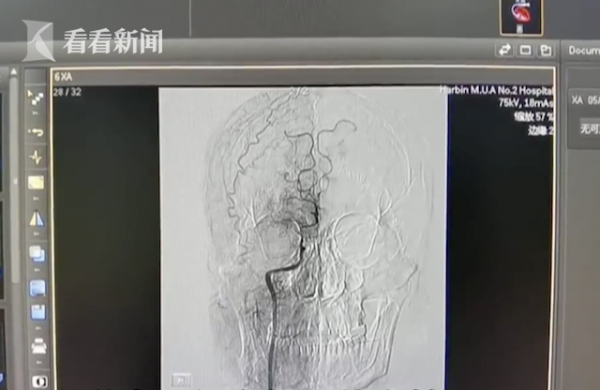 27歲小夥患上腦梗 大腦內血管竟“煙霧繚繞”